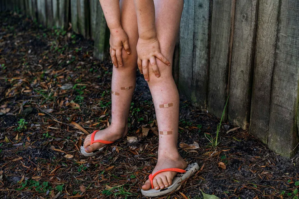 Pieter Hugo, Mosquito bites, Nature’s Valley