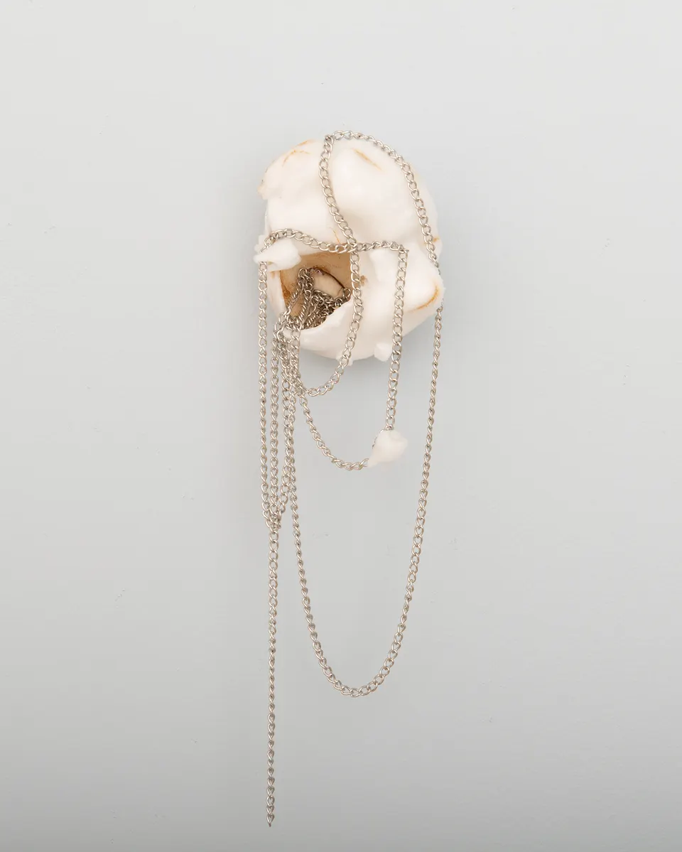 Xin Liu, Teratoma